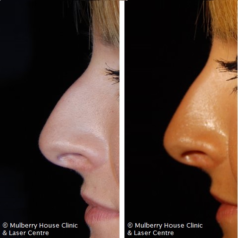 Before and after non-surgical nose job